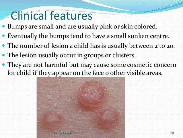 Mons Pubis Lump Under Skin Lump In Pubic Area Male