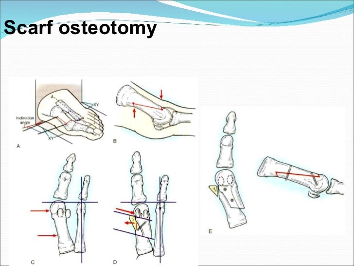 Disorders of the hallux