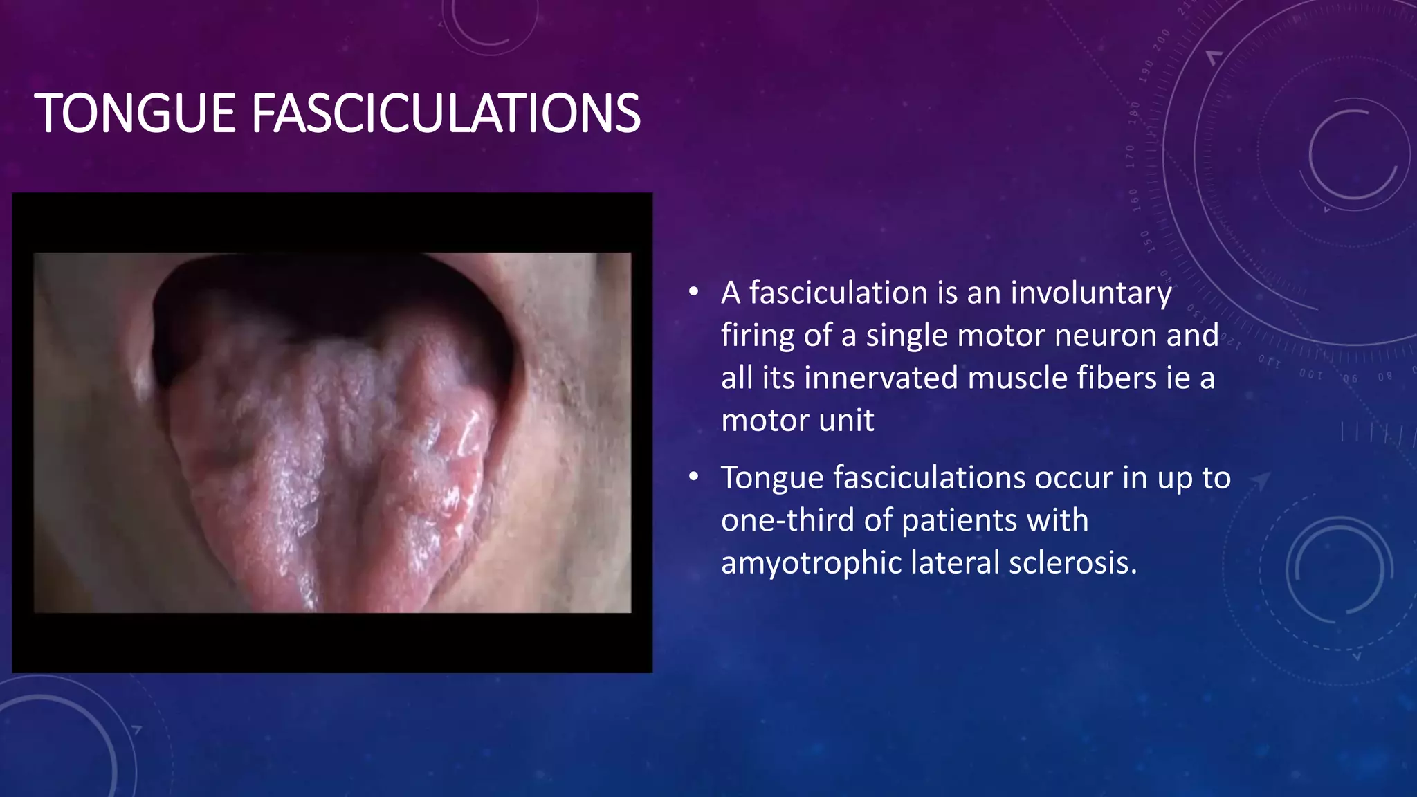 Disorders of the hypoglossal nerves PPT