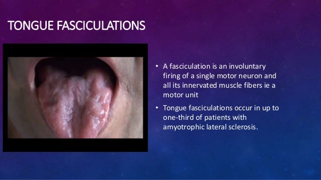 Disorders of the hypoglossal nerves Disorders of the hypoglossal nerves