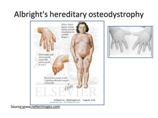 Albright's hereditary osteodystrophy
Source:www.netterimages.com
 