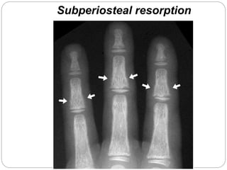 Subperiosteal resorption
 
