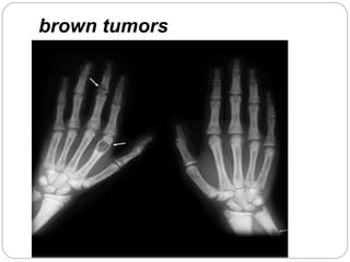 brown tumors
 
