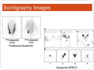 Scintigraphy Images
Traditional Sestamibi
Sestamibi-SPECT
 