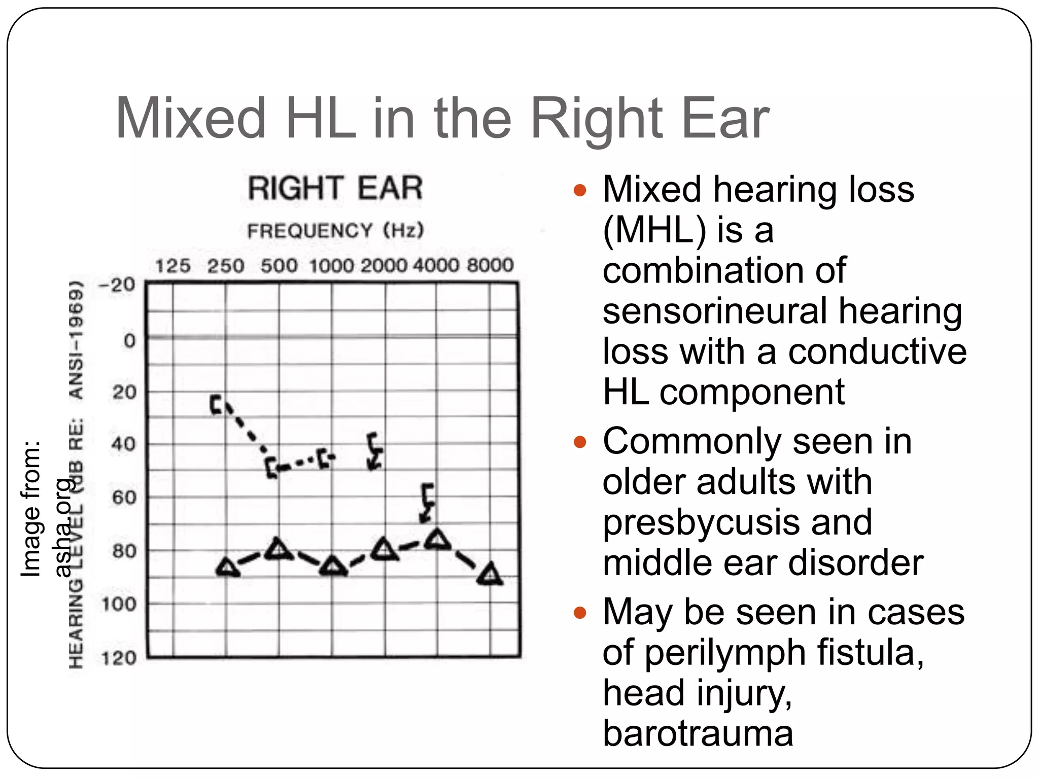 Mixed HL in the Right Ear
 Mixed hearing loss
(MHL) is a
combination of
sensorineural hearing
loss with a conductive
HL component
 Commonly seen in
older adults with
presbycusis and
middle ear disorder
 May be seen in cases
of perilymph fistula,
head injury,
barotrauma
Imagefrom:
asha.org
 