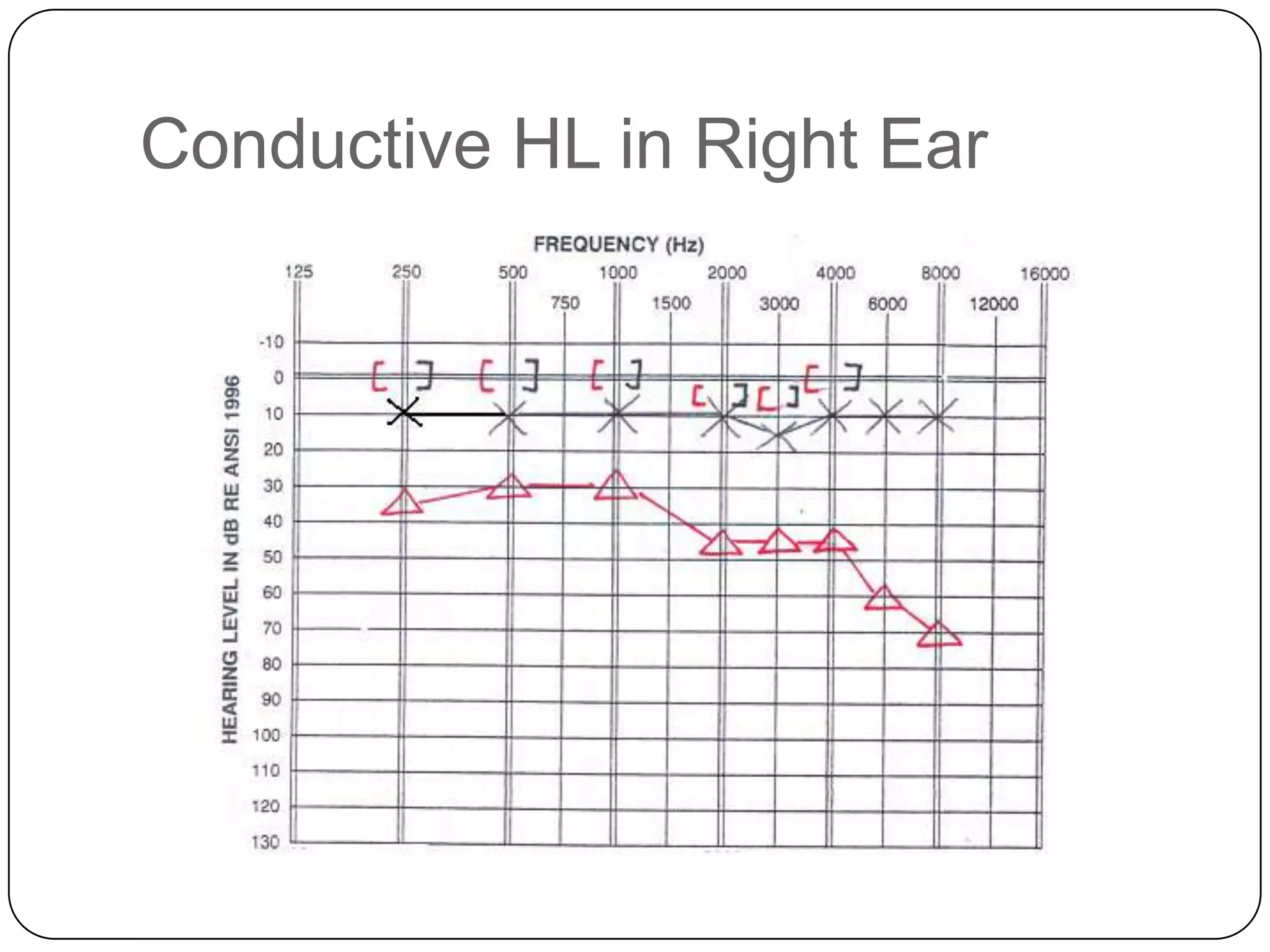 Conductive HL in Right Ear
 