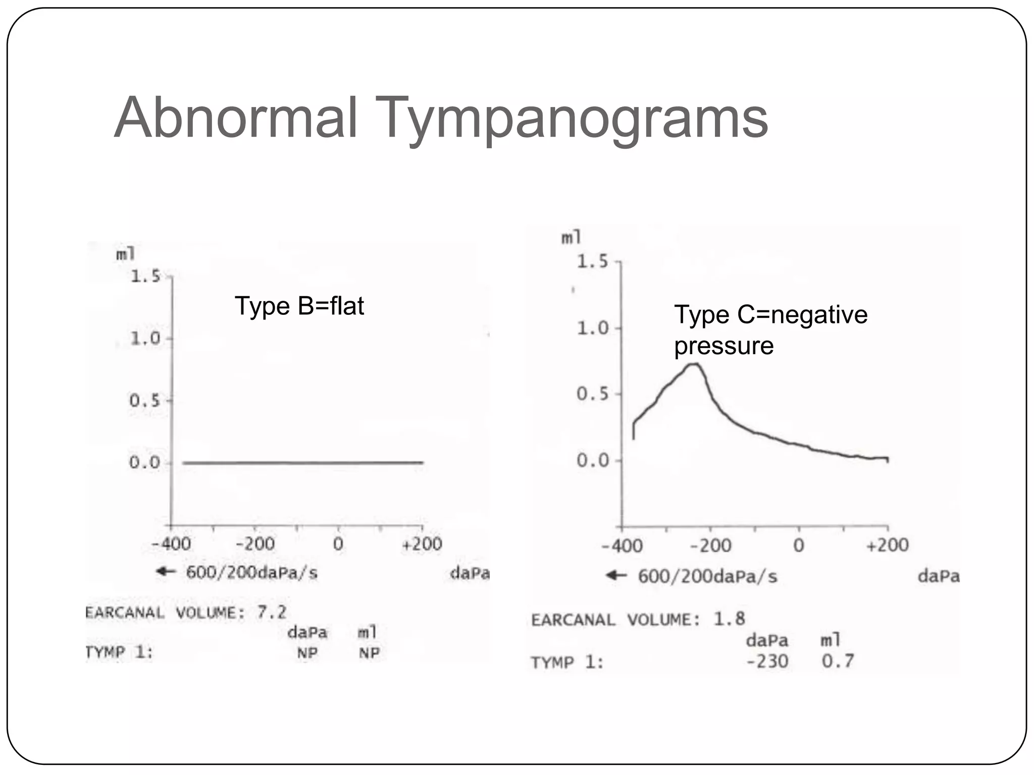 Abnormal Tympanograms
Type B=flat Type C=negative
pressure
 