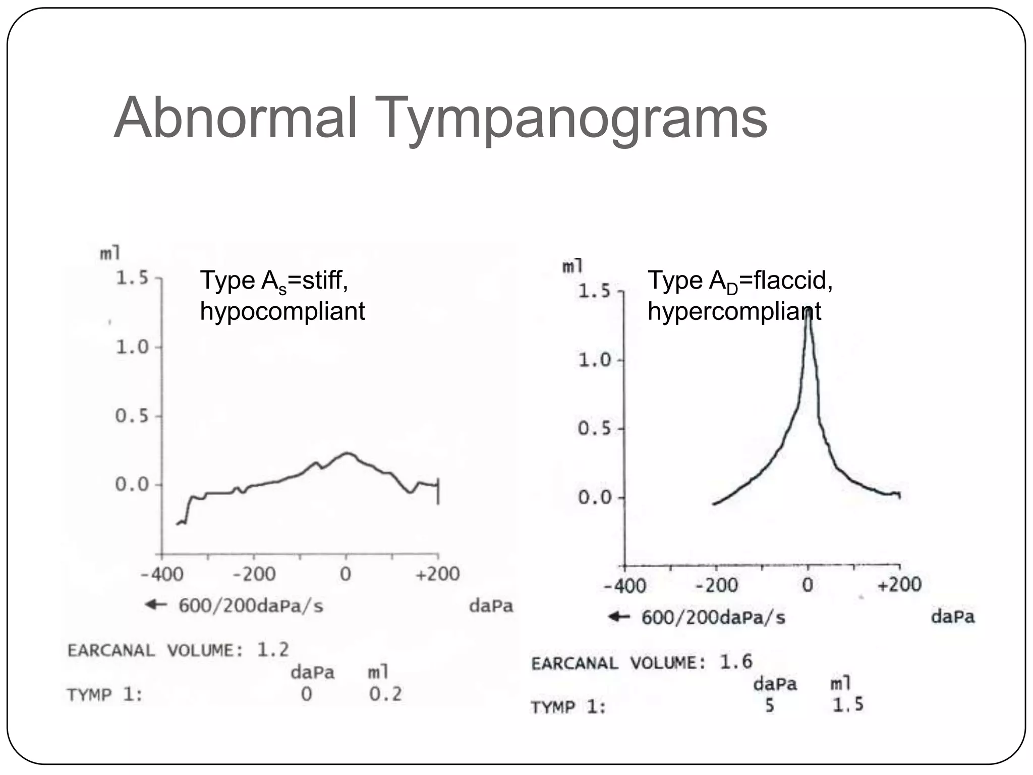 Abnormal Tympanograms
Type As=stiff,
hypocompliant
Type AD=flaccid,
hypercompliant
 