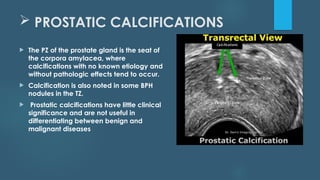 Prostate Calcification DISORDERS OF THE PROSTATE GLAND Radiology | PPTX