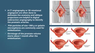 Pva Embolization Rmm DISORDERS OF THE PROSTATE GLAND Radiology | PPTX