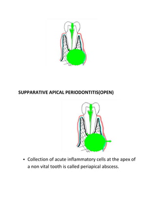 SUPPARATIVE APICAL PERIODONTITIS(OPEN)
• Collection of acute inflammatory cells at the apex of
a non vital tooth is called...
