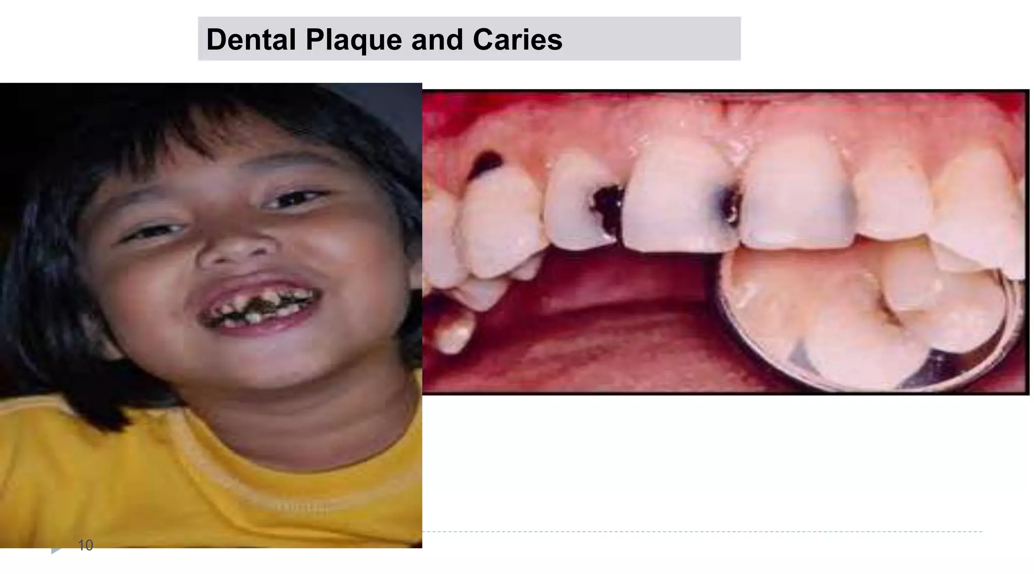Dental Plaque and Caries
10
 