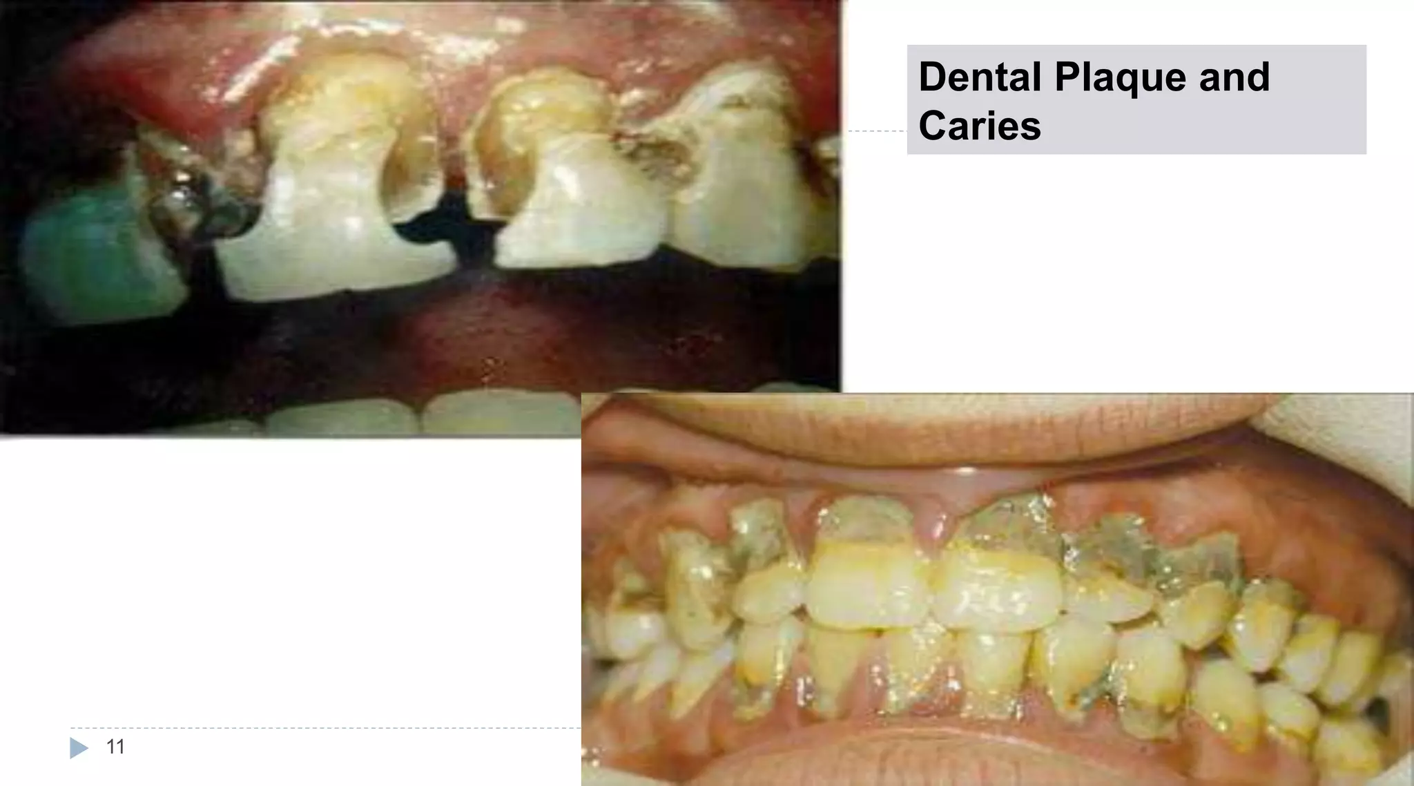 Dental Plaque and
Caries
11
 