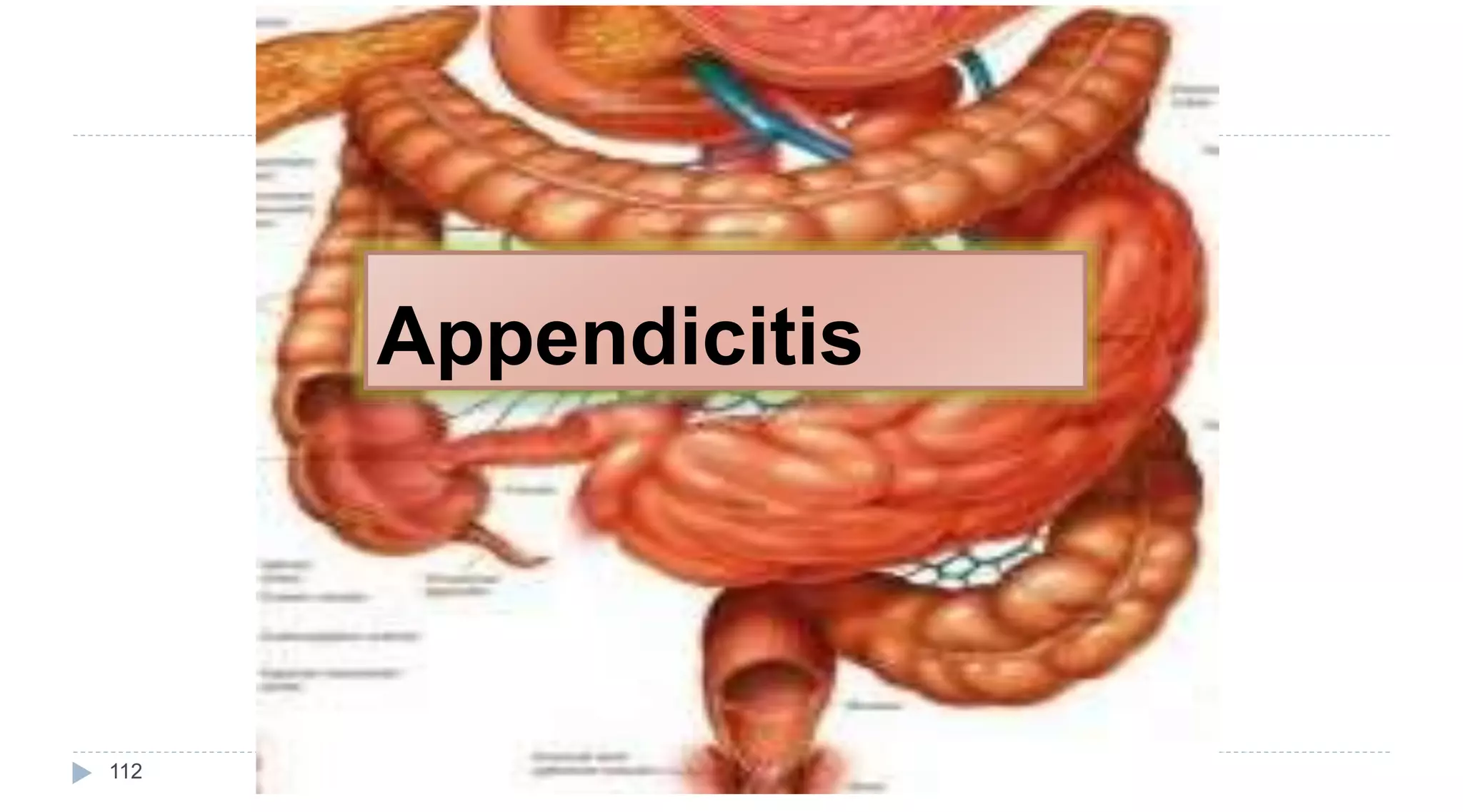 Appendicitis
112
 