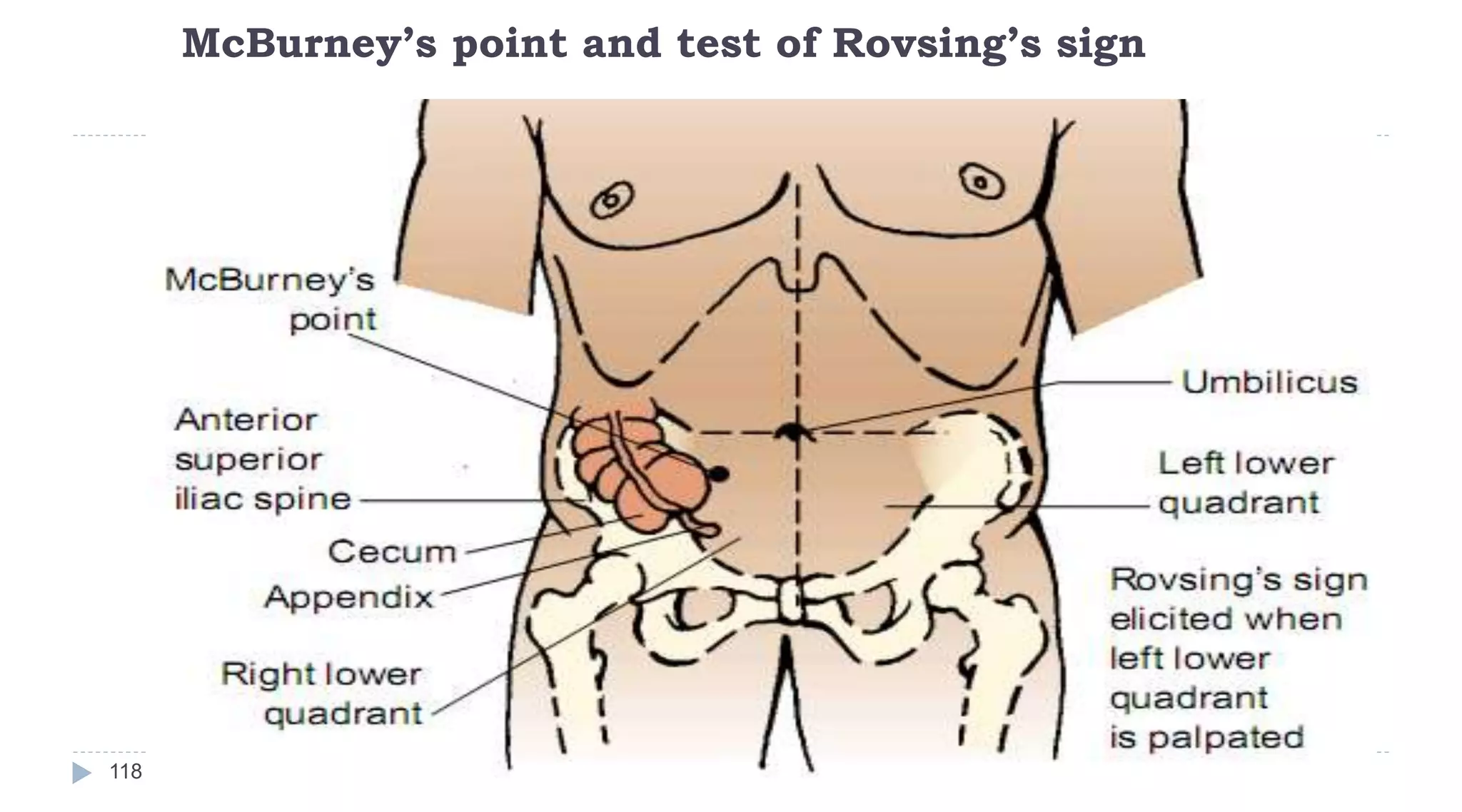 McBurney’s point and test of Rovsing’s sign
118
 