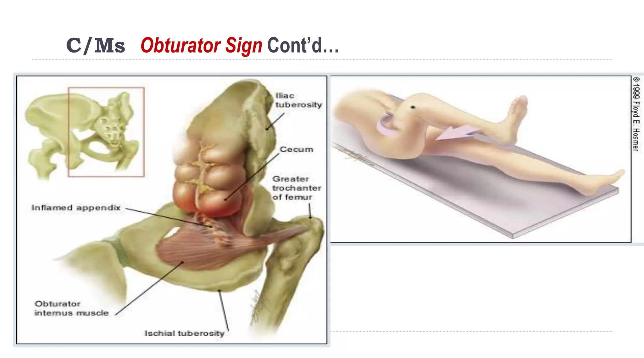 C/Ms Obturator Sign Cont’d…
122
 