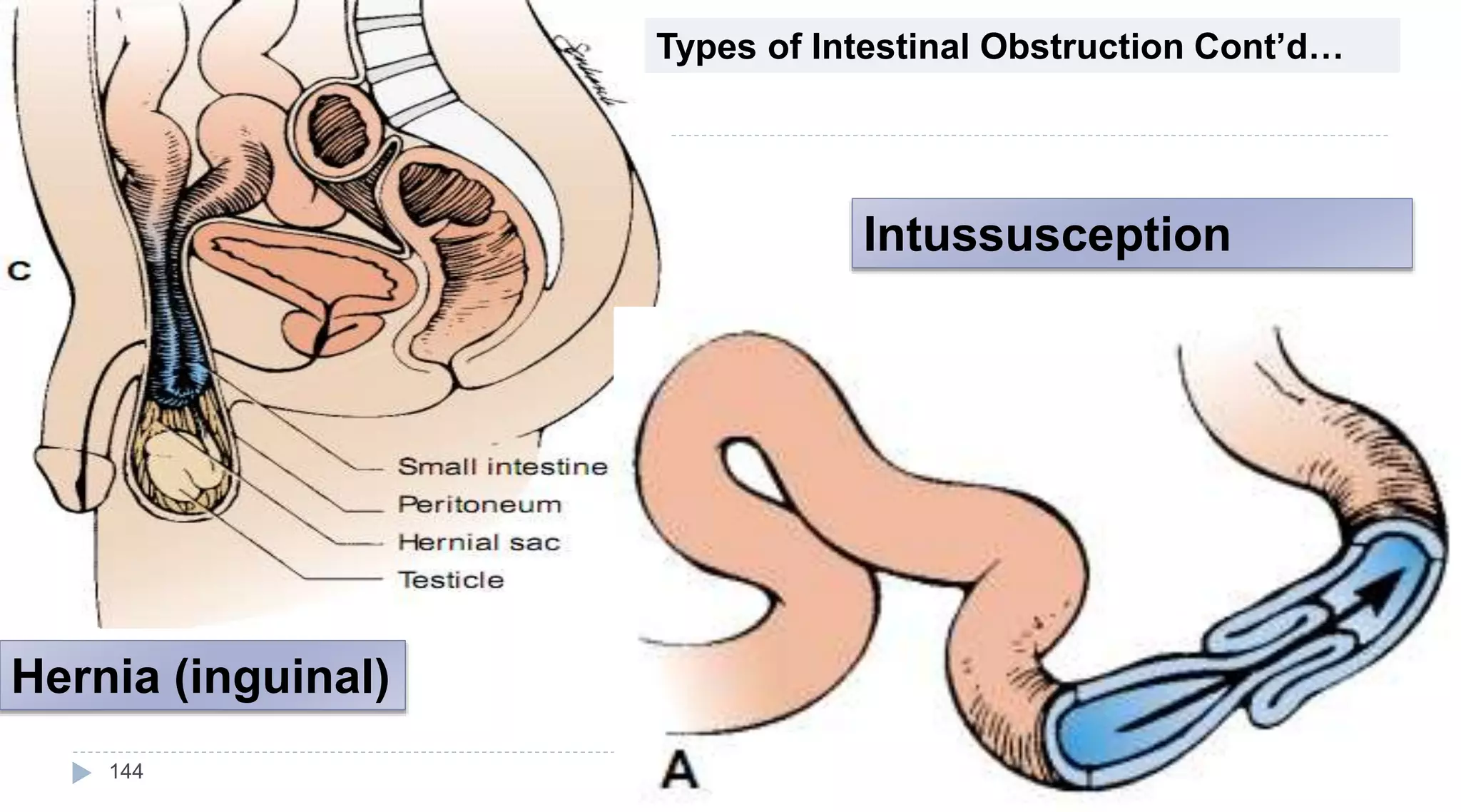 Hernia (inguinal)
Intussusception
Types of Intestinal Obstruction Cont’d…
144
 