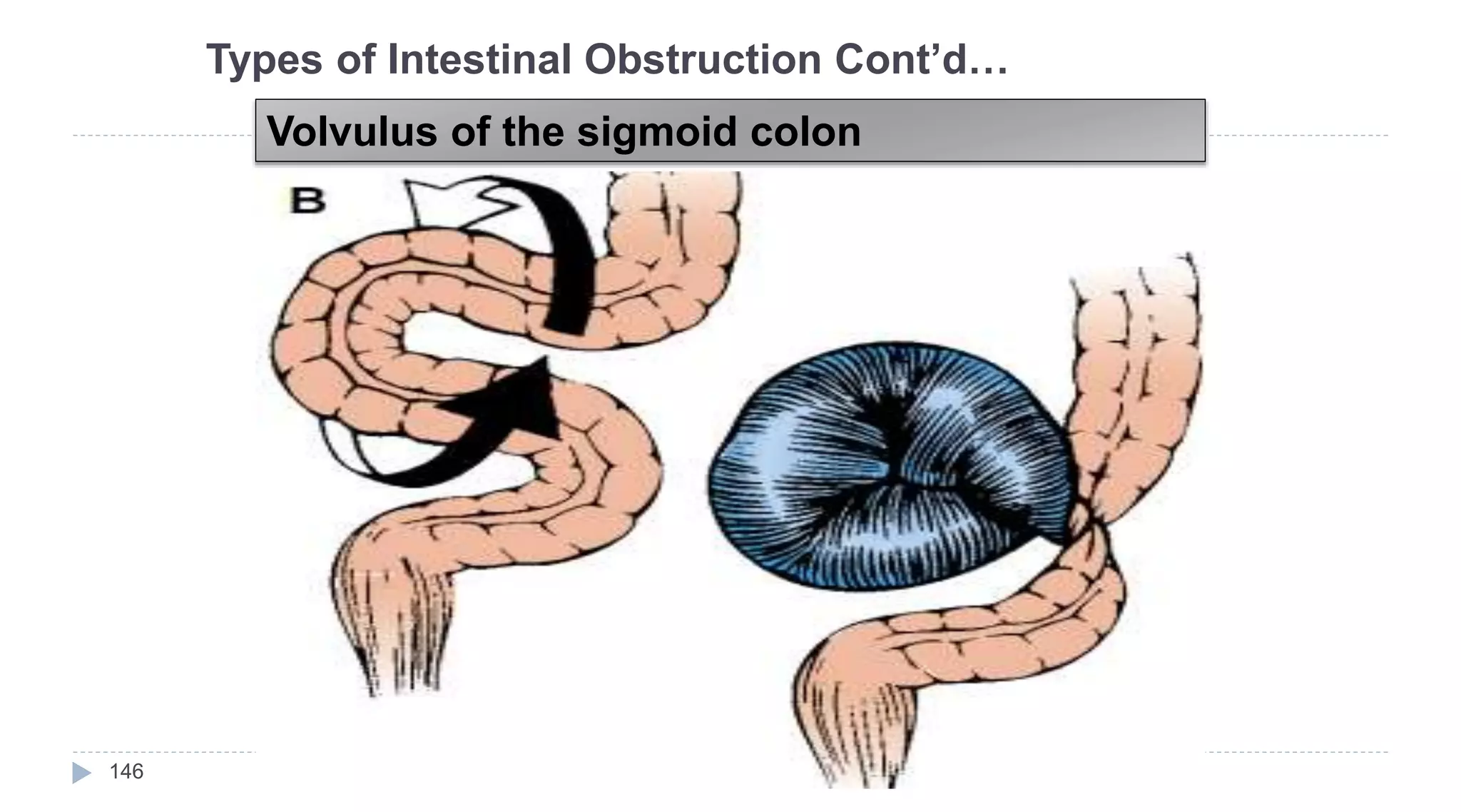 Volvulus of the sigmoid colon
Types of Intestinal Obstruction Cont’d…
146
 
