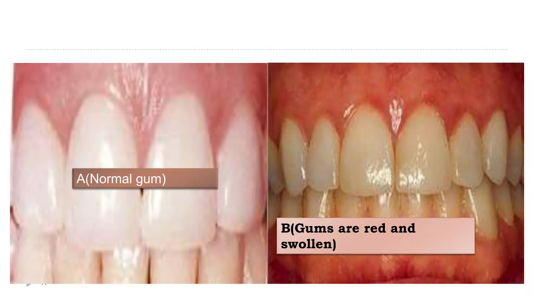 17
A(Normal gum)
B(Gums are red and
swollen)
 