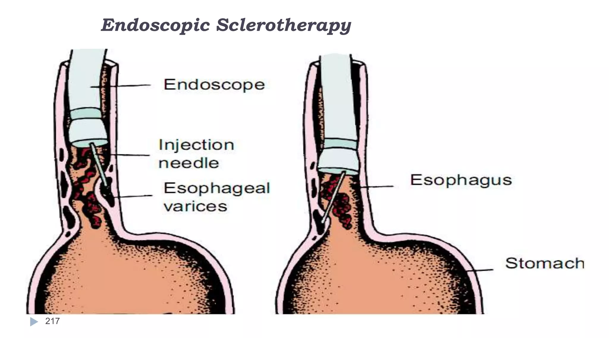 Endoscopic Sclerotherapy
217
 