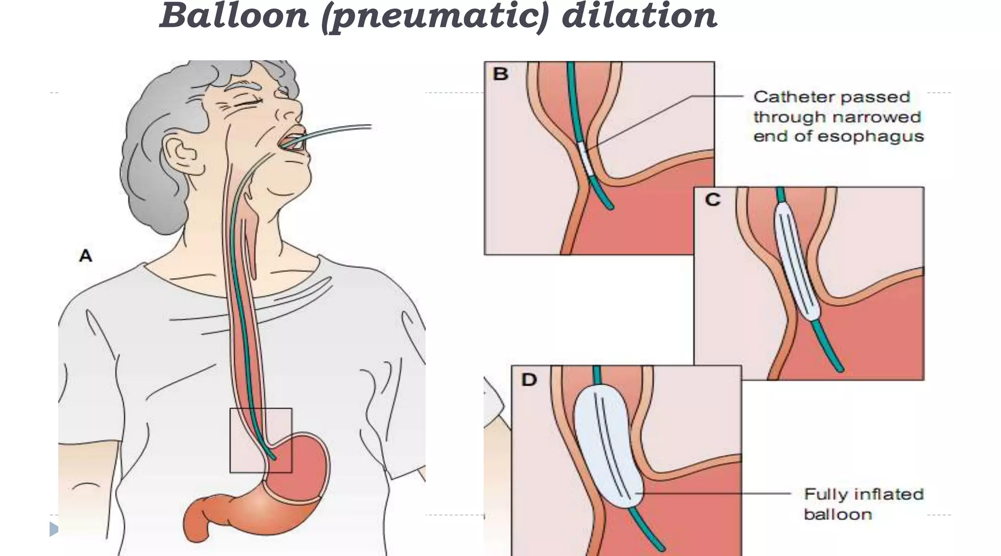 Balloon (pneumatic) dilation
44
 