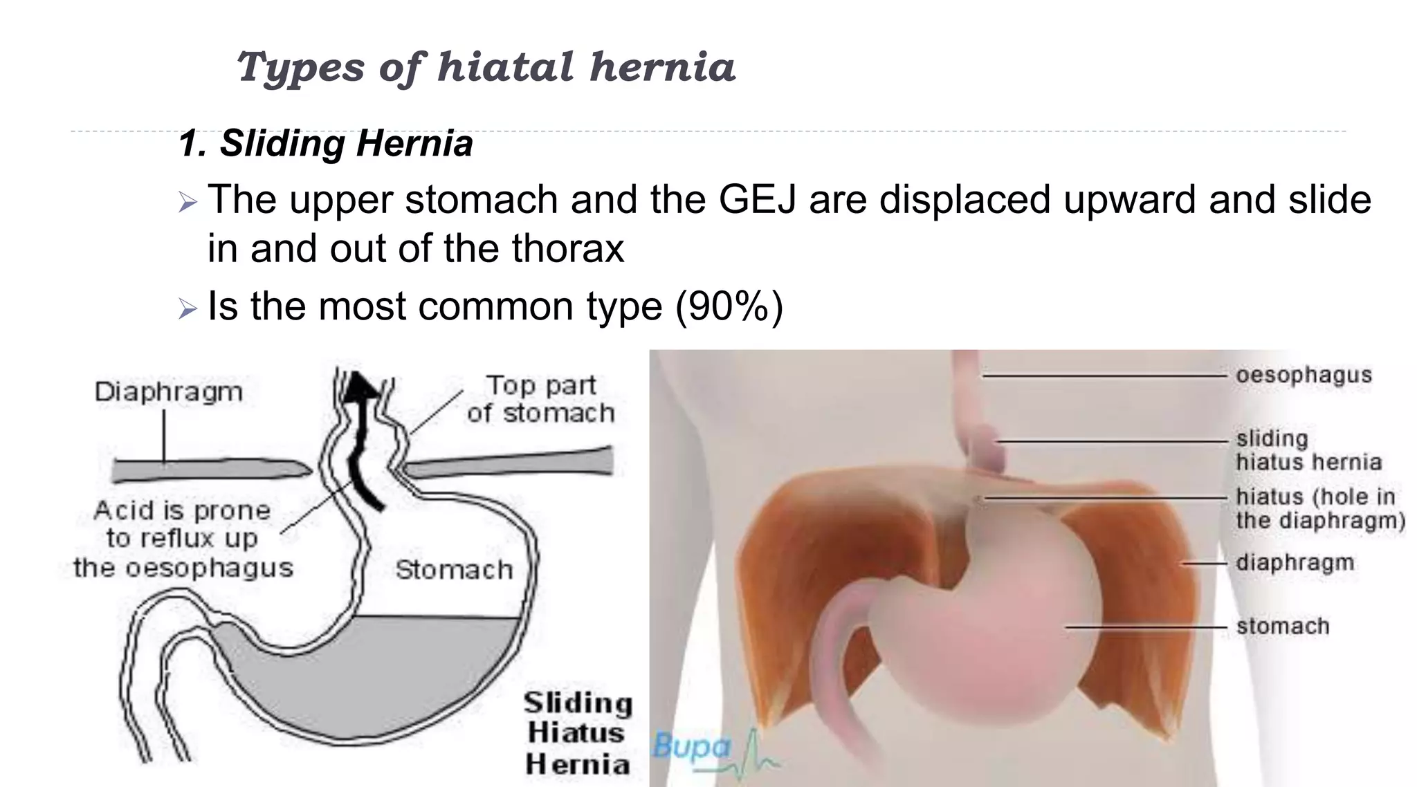 Types of hiatal hernia
46
1. Sliding Hernia
 The upper stomach and the GEJ are displaced upward and slide
in and out of the thorax
 Is the most common type (90%)
 