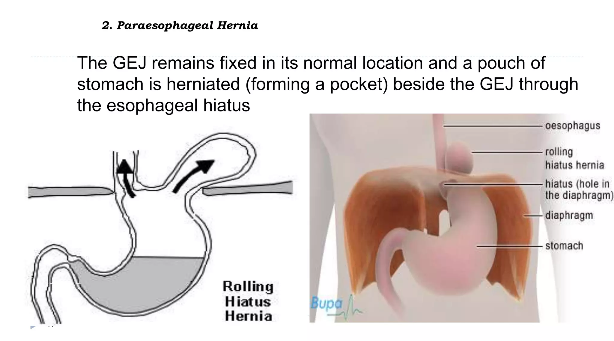 2. Paraesophageal Hernia
47
The GEJ remains fixed in its normal location and a pouch of
stomach is herniated (forming a pocket) beside the GEJ through
the esophageal hiatus
 