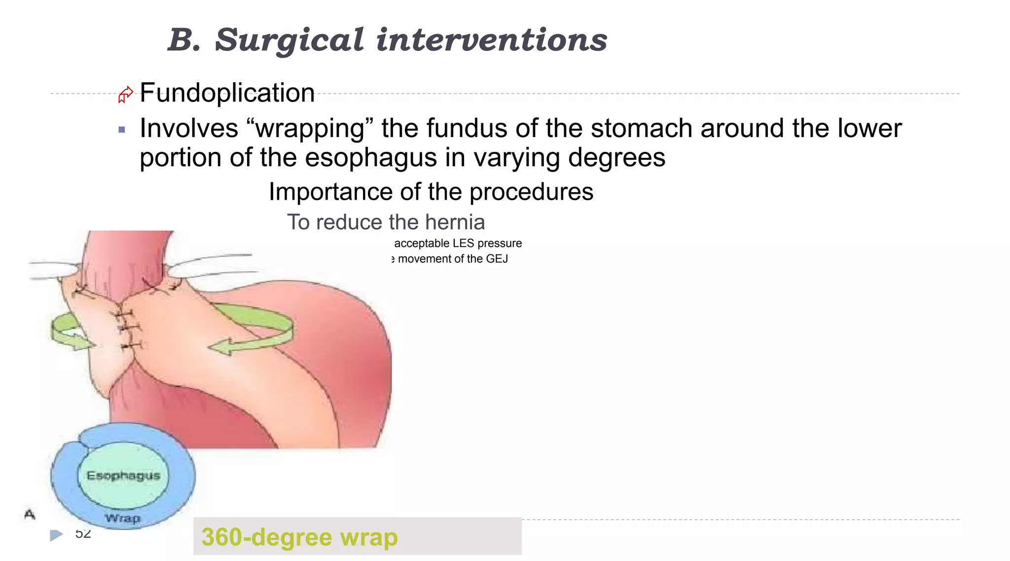B. Surgical interventions
52
 Fundoplication
 Involves “wrapping” the fundus of the stomach around the lower
portion of the esophagus in varying degrees
Importance of the procedures
To reduce the hernia
 To provide an acceptable LES pressure
 To prevent the movement of the GEJ
360-degree wrap
 