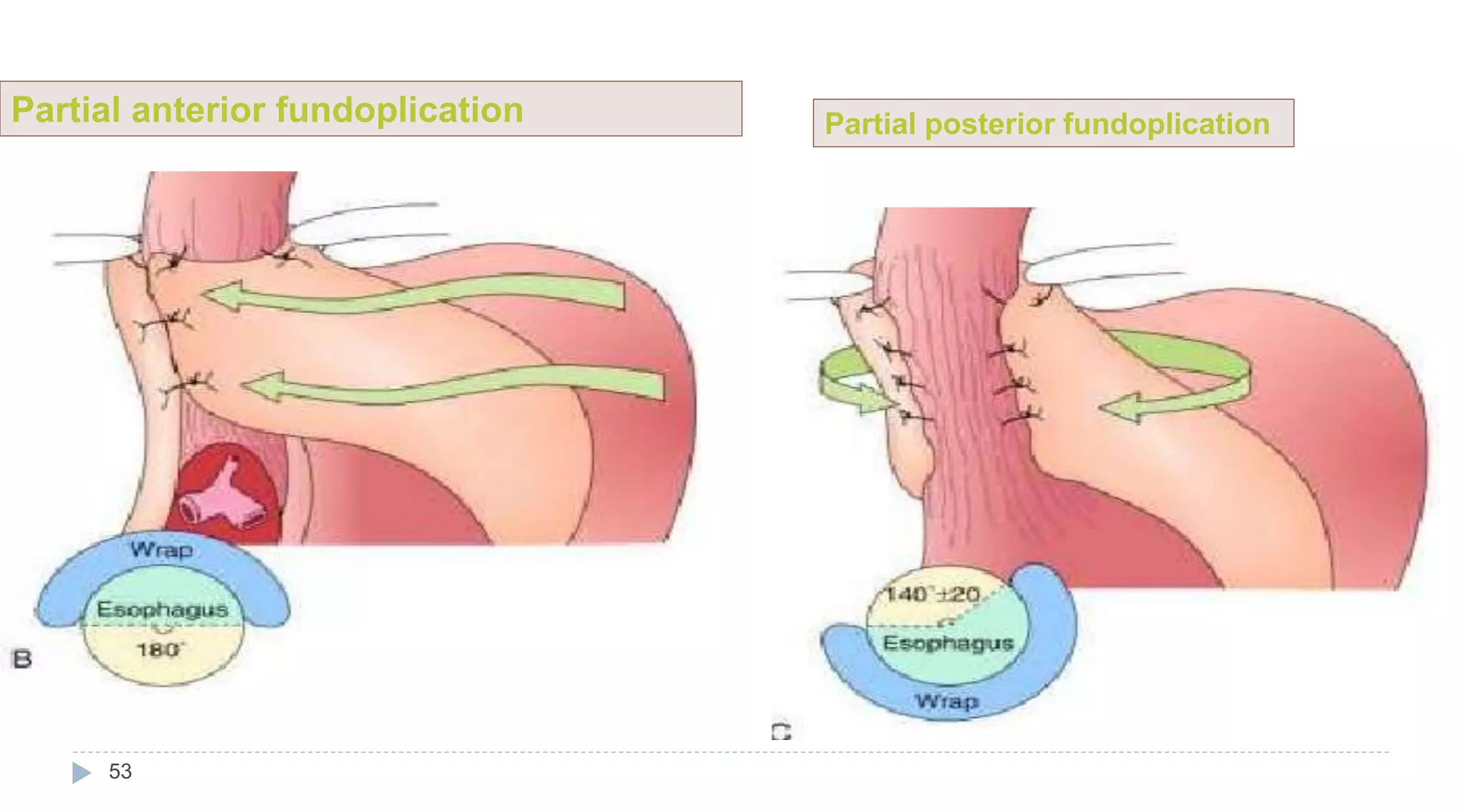 53
Partial anterior fundoplication Partial posterior fundoplication
 