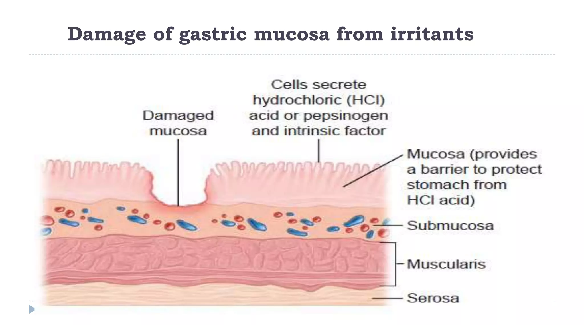 Damage of gastric mucosa from irritants
75
 