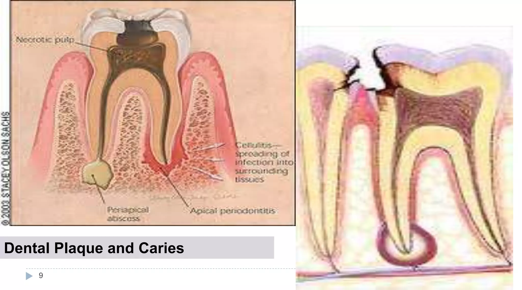 Dental Plaque and Caries
9
 