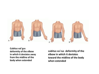 Cubitus val´gus
deformity of the elbow
in which it deviates away
from the midline of the
body when extended
cubitus va´rus deformity of the
elbow in which it deviates
toward the midline of the body
when extended
 