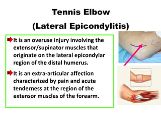 It is an overuse injury involving the
extensor/supinator muscles that
originate on the lateral epicondylar
region of the distal humerus.
It is an extra-articular affection
characterized by pain and acute
tenderness at the region of the
extensor muscles of the forearm.
Tennis Elbow
(Lateral Epicondylitis)
 