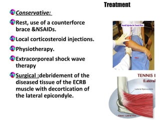 Conservative:
Rest, use of a counterforce
brace &NSAIDs.
Local corticosteroid injections.
Physiotherapy.
Extracorporeal shock wave
therapy
Surgical :debridement of the
diseased tissue of the ECRB
muscle with decortication of
the lateral epicondyle.
Treatment
 