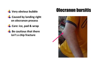 Very obvious bubble
Caused by landing right
on olecranon process
Care: ice, pad & wrap
Be cautious that there
isn’t a chip fracture
Olecranon bursitis
 
