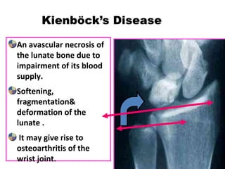 An avascular necrosis of
the lunate bone due to
impairment of its blood
supply.
Softening,
fragmentation&
deformation of the
lunate .
It may give rise to
osteoarthritis of the
wrist joint.
Kienböck’s Disease
 