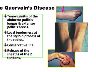 Tenovaginitis of the
abductor pollicis
longus & extensor
pollicis brevis.
Local tenderness at
the styloid process of
the radius.
Conservative TTT.
Release of the
sheaths of the 2
tendons.
e Quervain’s Disease
 