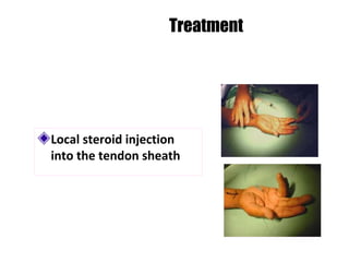 Local steroid injection
into the tendon sheath
Treatment
 