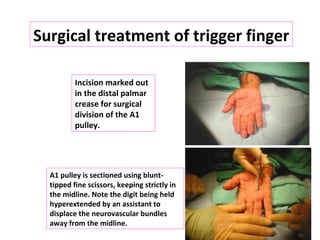 Incision marked out
in the distal palmar
crease for surgical
division of the A1
pulley.
A1 pulley is sectioned using blunt-
tipped fine scissors, keeping strictly in
the midline. Note the digit being held
hyperextended by an assistant to
displace the neurovascular bundles
away from the midline.
Surgical treatment of trigger finger
 