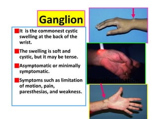 It is the commonest cystic
swelling at the back of the
wrist.
The swelling is soft and
cystic, but it may be tense.
Asymptomatic or minimally
symptomatic.
Symptoms such as limitation
of motion, pain,
paresthesias, and weakness.
Ganglion
Transillumination
 
