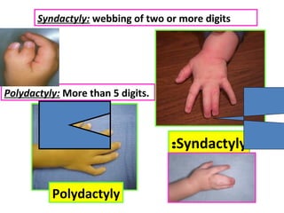 Syndactyly:
Polydactyly
Syndactyly: webbing of two or more digits
Polydactyly: More than 5 digits.
 