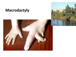 Macrodactyly
 
