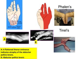 Tinel’s
Phalen’s
M E D IA N
N E RV E
C A R PA L
L IG A M E N T
T E N D O N SB O N E S
A: A flattened thenar eminence
indicates atrophy of the abductor
pollicis brevis.
B: Abductor pollicis brevis
A
B
 