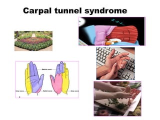 Carpal tunnel syndrome
 