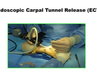 ndoscopic Carpal Tunnel Release (ECT
 