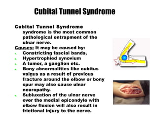 Cubital Tunnel Syndrome
syndrome is the most common
pathological entrapment of the
ulnar nerve.
Causes: It may be caused by:
1. Constricting fascial bands,
2. Hypertrophied synovium
3. A tumor, a ganglion etc.
4. Bony abnormalities like cubitus
valgus as a result of previous
fracture around the elbow or bony
spur may also cause ulnar
neuropathy.
5. Subluxation of the ulnar nerve
over the medial epicondyle with
elbow flexion will also result in
frictional injury to the nerve.
Cubital Tunnel Syndrome
 