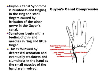 Guyon's Canal Syndrome
is numbness and tingling
in the ring and small
fingers caused by
irritation of the ulnar
nerve in the Guyon's
canal.
Symptoms begin with a
feeling of pins and
needles in ring and little
finger.
This is followed by
decreased sensation and
eventually weakness and
clumsiness in the hand as
the small muscles of the
hand are involved.
Guyon’s Canal Compression
 