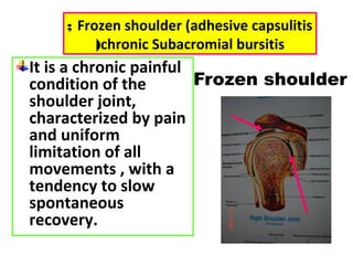 It is a chronic painful
condition of the
shoulder joint,
characterized by pain
and uniform
limitation of all
movements , with a
tendency to slow
spontaneous
recovery.
Frozen shoulder (adhesive capsulitis;
chronic Subacromial bursitis(
Frozen shoulder
 