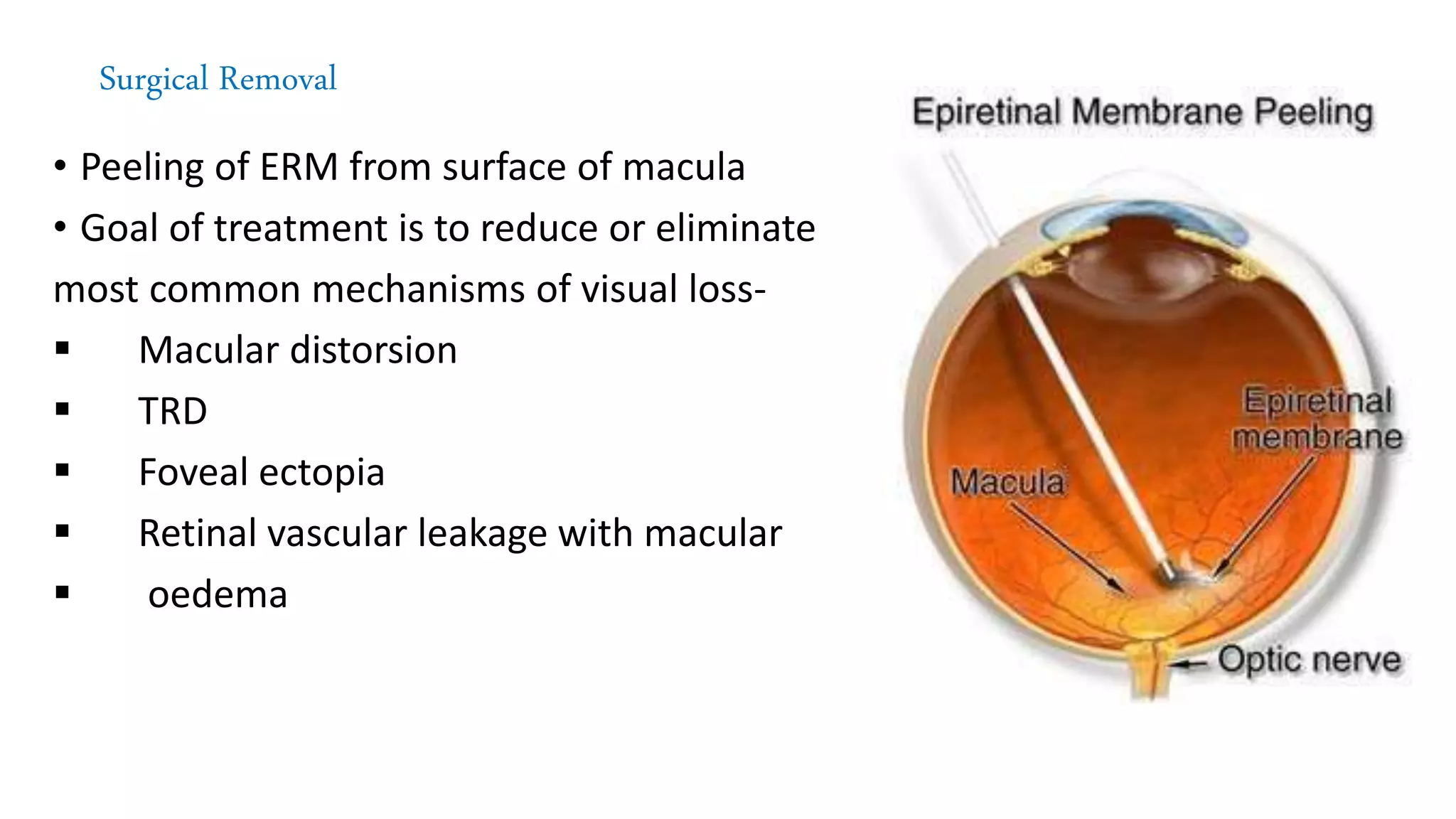 Disorders of vitreomacular interface by dr navid | PPTX