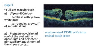 Disorders of vitreomacular interface by dr navid | PPTX